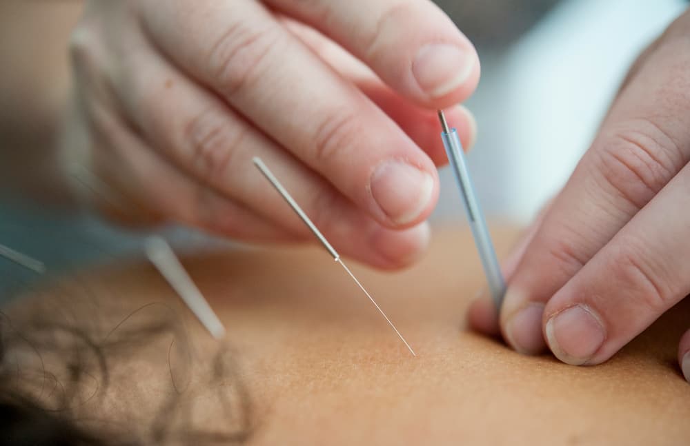 a patient recieving dry needle treatment in back